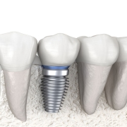 Dental Implants
