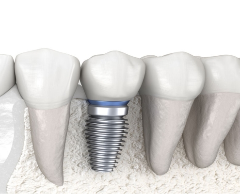 Dental Implants