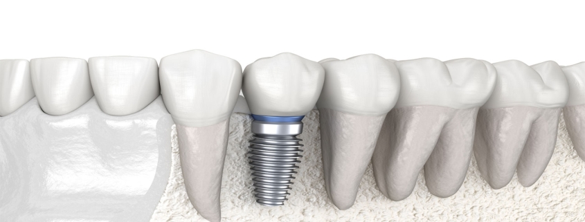 Dental Implants
